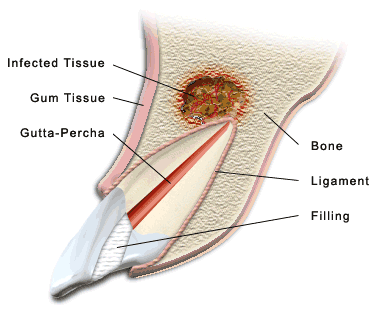 What is an Apicoectomy