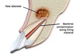 Endodontic Retreatment 