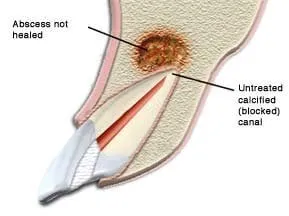 Endodontic Retreatment
